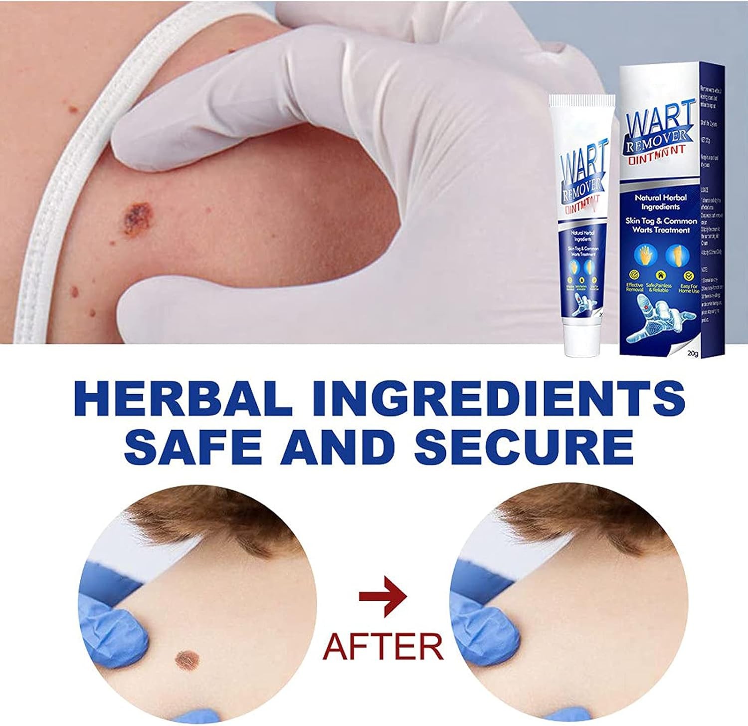 🌿 كريم إزالة الثآليل والزوائد الجلدية – إزالة فعّالة بدون ألم وبدون ندوب