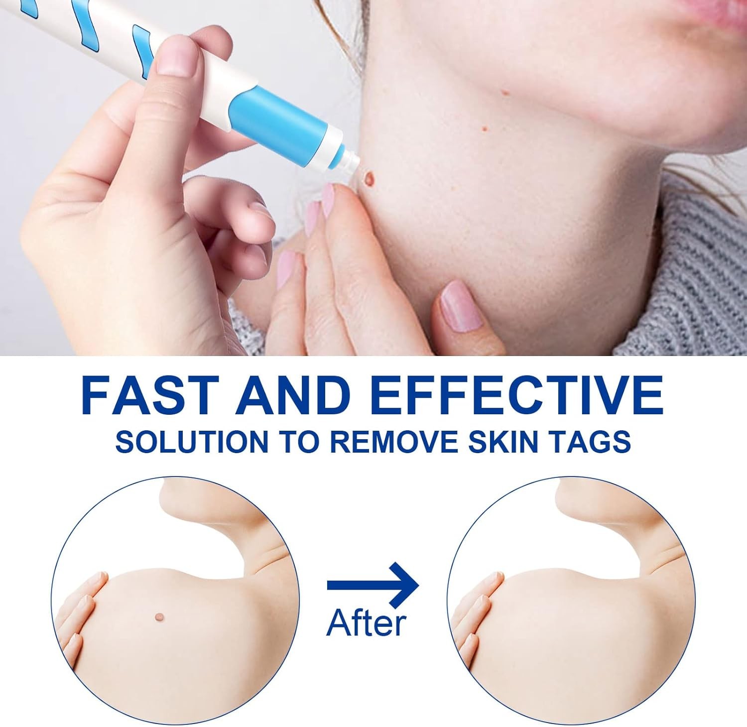 ✨ KANZA – مجموعة إزالة الزوائد الجلدية الصغيرة والمتوسطة | آمنة، فعّالة وغير مؤلمة للرجال والنساء