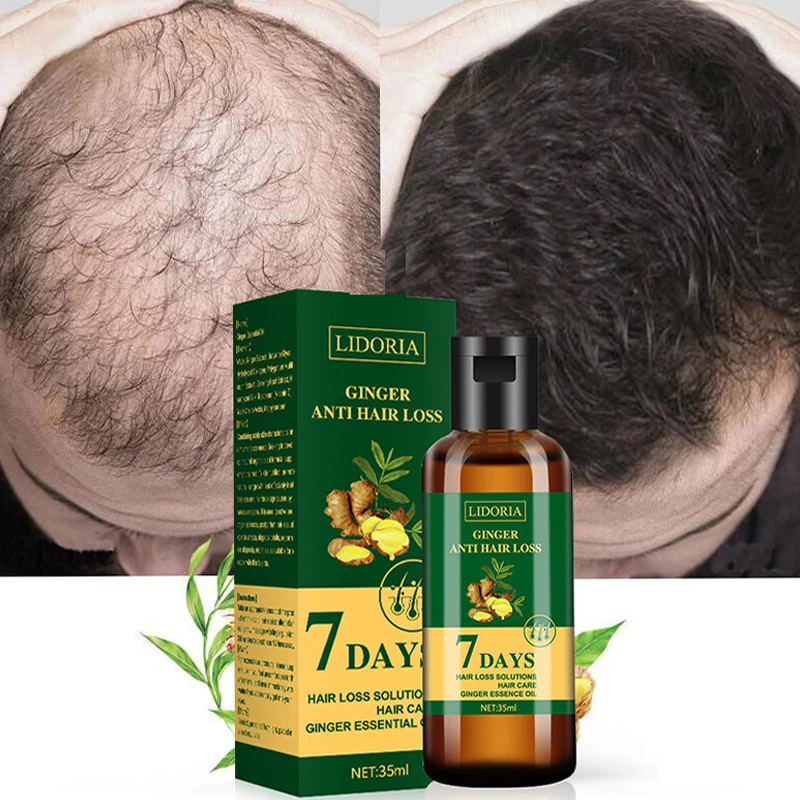 🧴 زيت الزنجبيل الحل الطبيعي لشعر أقوى – علاج تساقط الشعر خلال 7 أيام