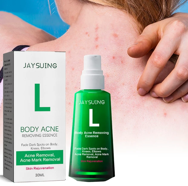 سيروم مضاد لحب الشباب